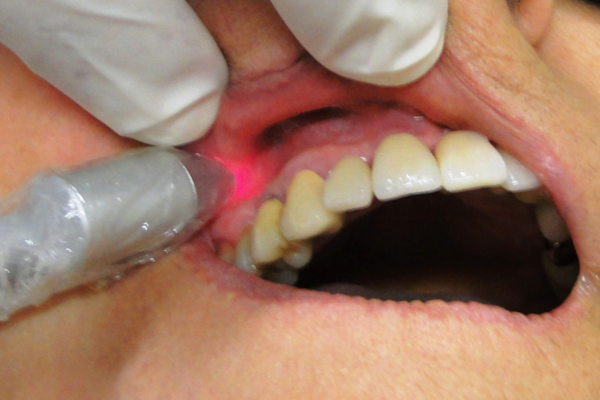 Low-level-laser-therapy-in-dentistry-1200x800.jpg