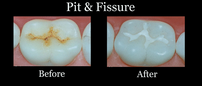 The Pit & Fissure Sealants - Procedure | Alux Dental