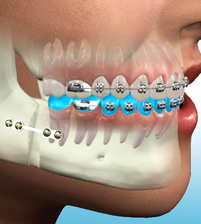 Surgical Orthodontics Procedure Hyderabad | Alux Dental