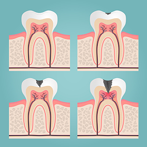 dental-fillings-img-2.jpg