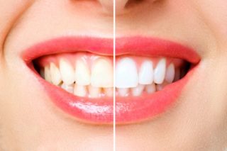 teeth-whitening-in-hyderabad-320x213-1.jpg