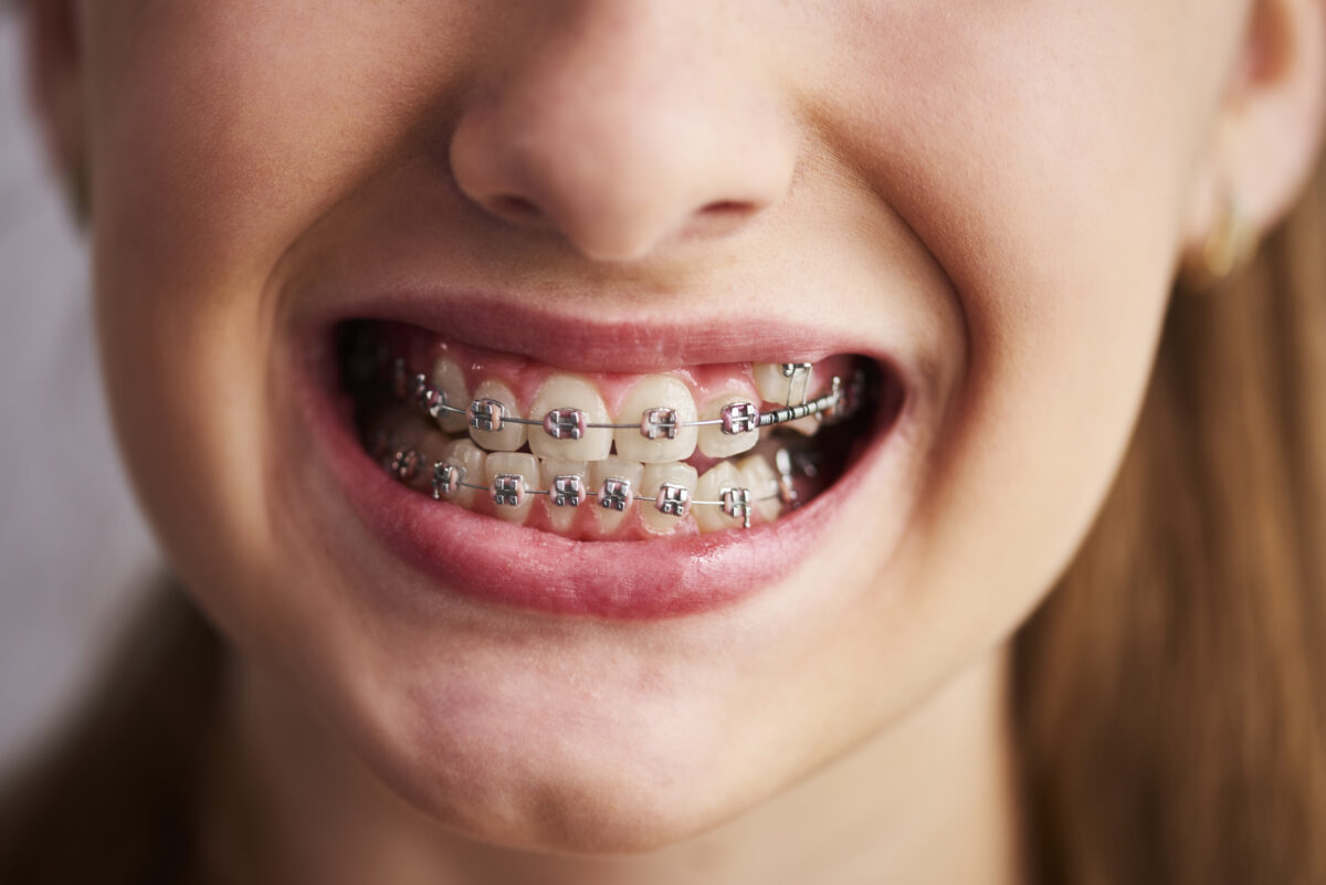 The Complete In and Outs of Braces Treatment